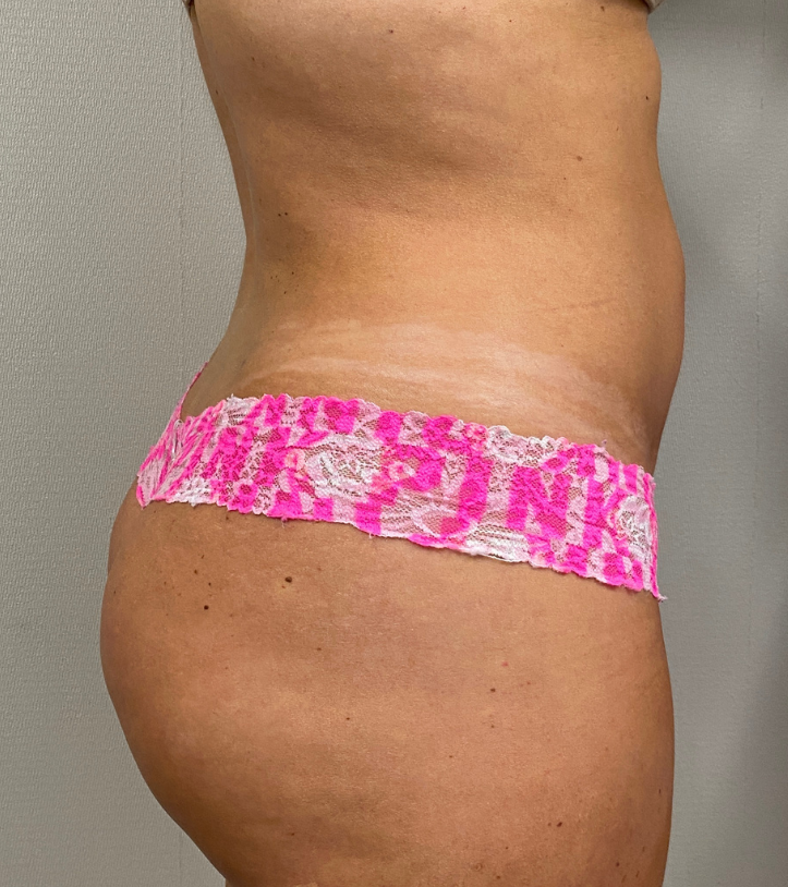 After Image: Brazilian Buttock Lift - right-side