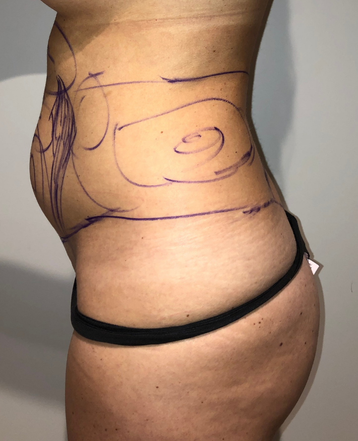 Before Image: Brazilian Buttock Lift - left-side