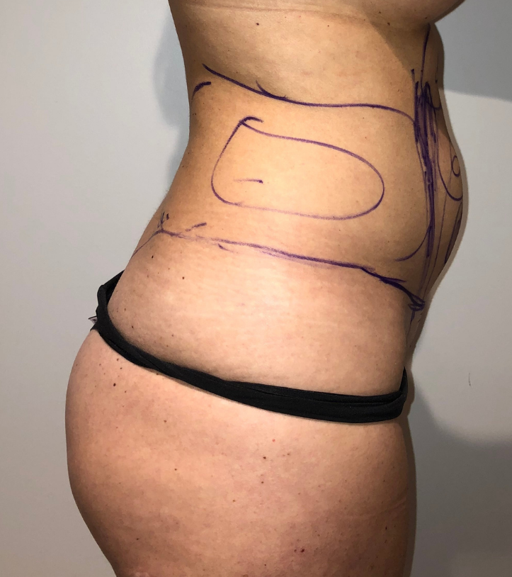 Before Image: Brazilian Buttock Lift - right-side