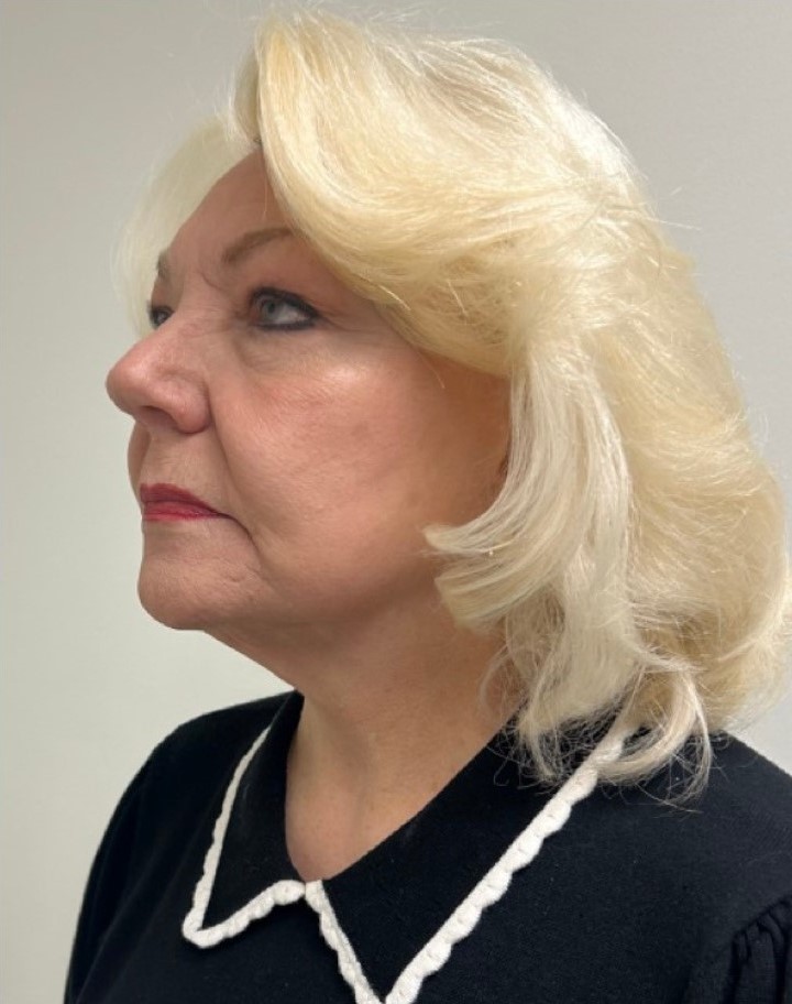 After Image: Facelift and Neck Lift - left-front-oblique