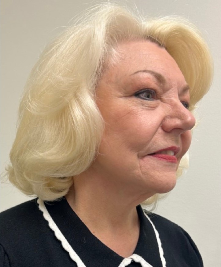 After Image: Facelift and Neck Lift - right-front-oblique