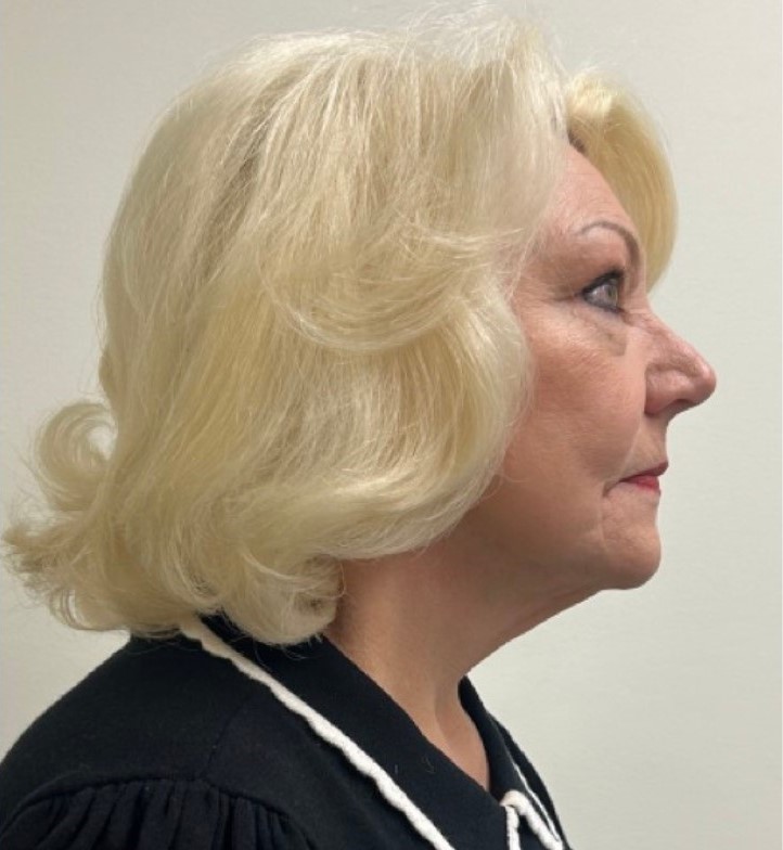 After Image: Facelift and Neck Lift - right-side