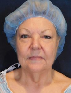 Before Image: Facelift and Neck Lift