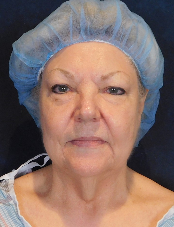 Before Image: Facelift and Neck Lift - front