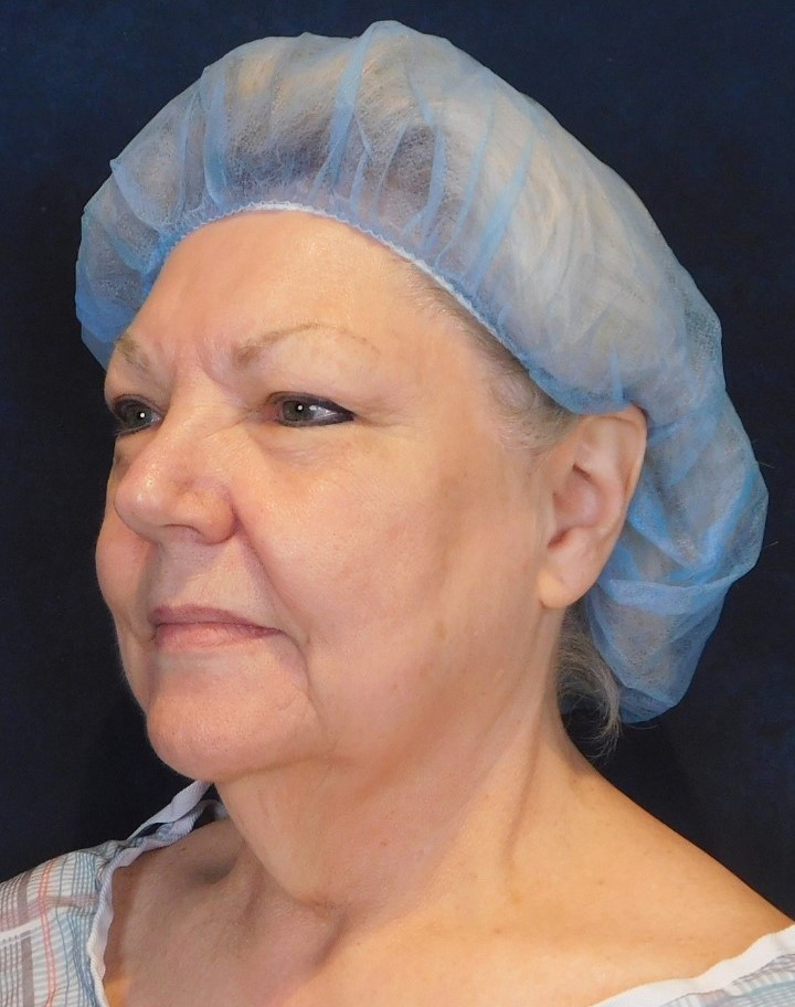 Before Image: Facelift and Neck Lift - left-front-oblique