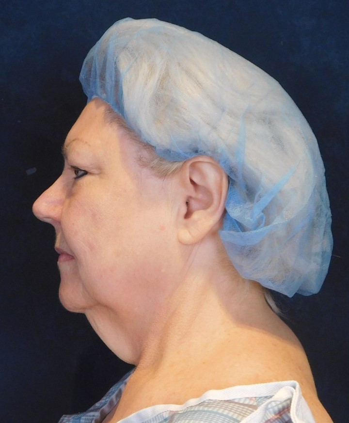 Before Image: Facelift and Neck Lift - left-side