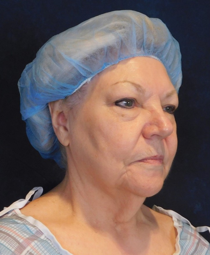 Before Image: Facelift and Neck Lift - right-front-oblique