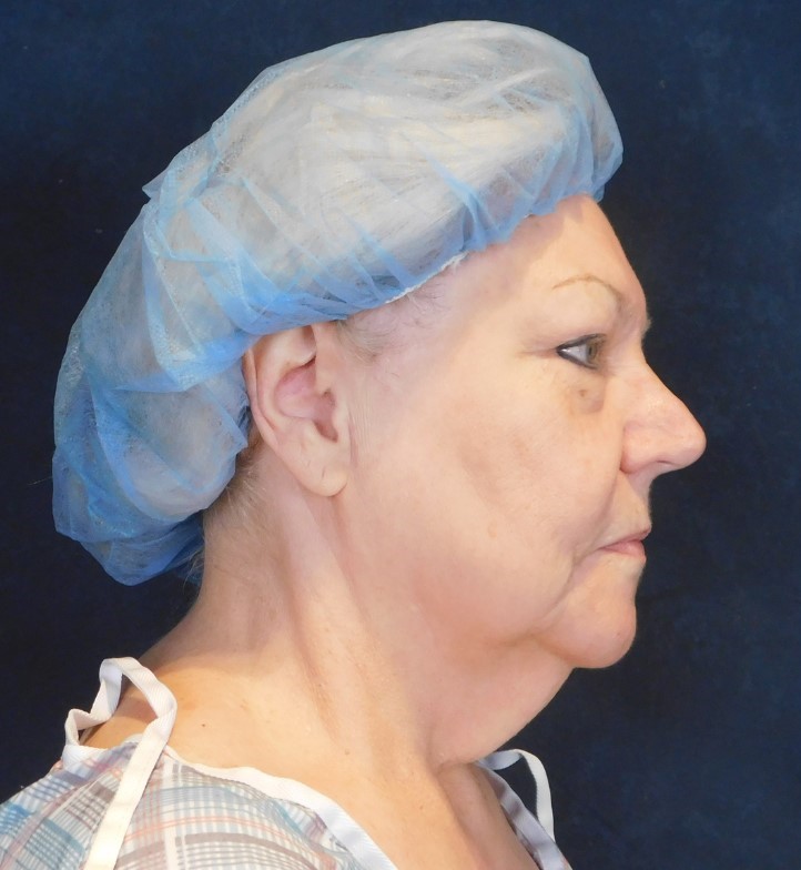 Before Image: Facelift and Neck Lift - right-side