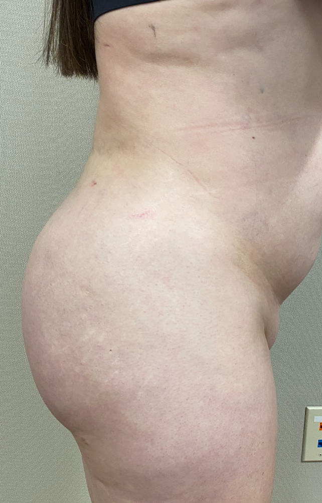 After Image: Brazilian Buttock Lift - right-side