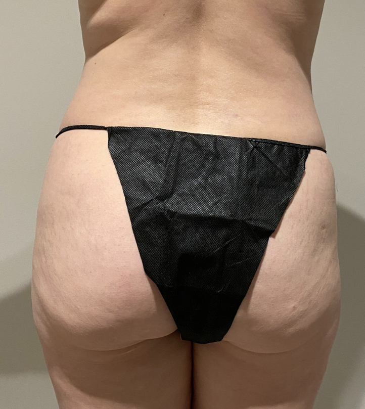 Before Image: Brazilian Buttock Lift - back