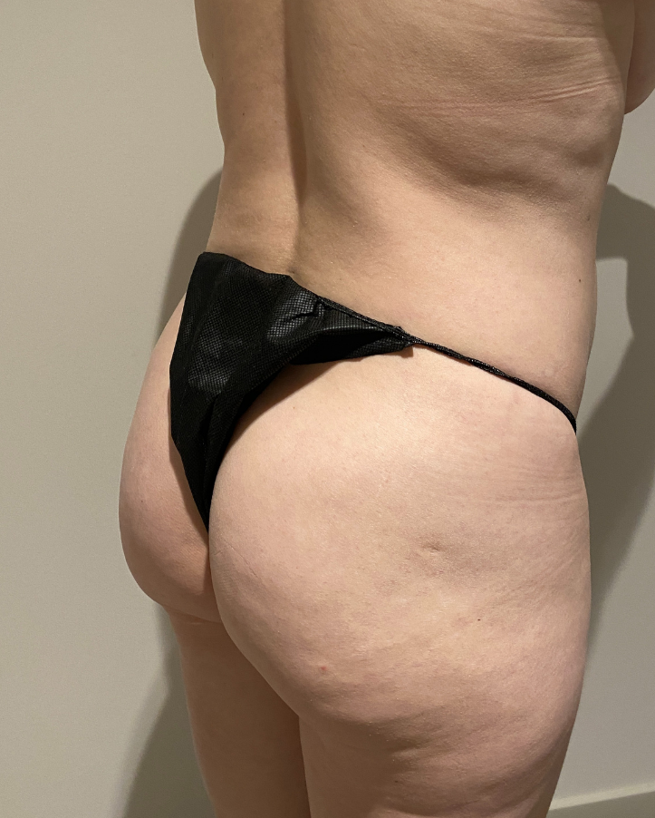 Before Image: Brazilian Buttock Lift - right-back-oblique