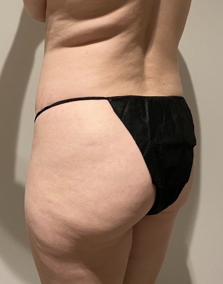 Before Image: Brazilian Buttock Lift - left-back-oblique