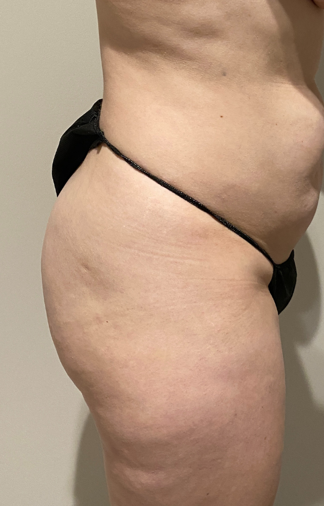 Before Image: Brazilian Buttock Lift - right-side