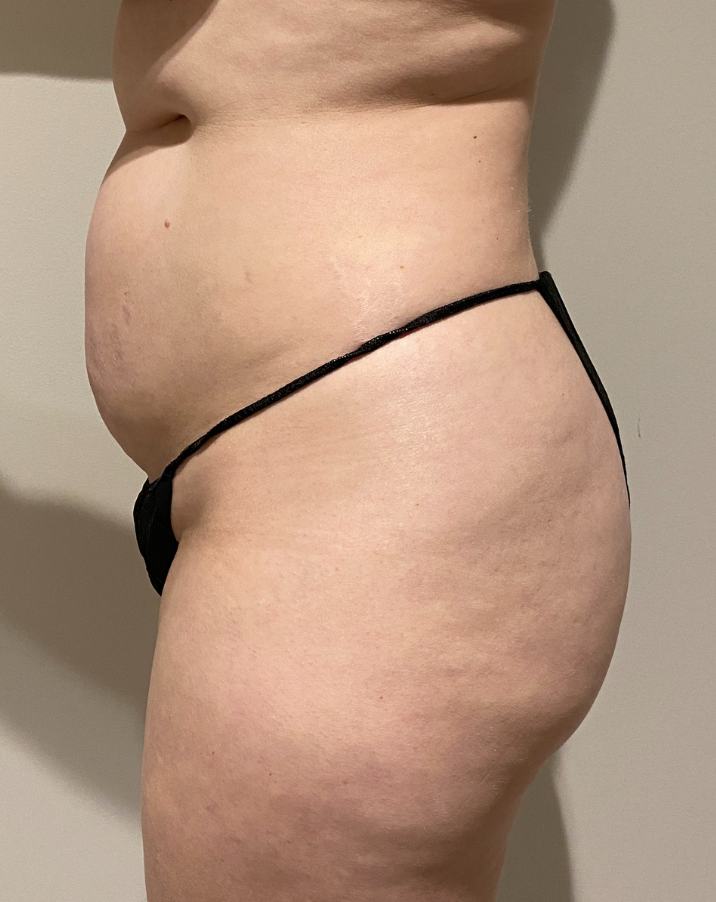 Before Image: Brazilian Buttock Lift - left-side