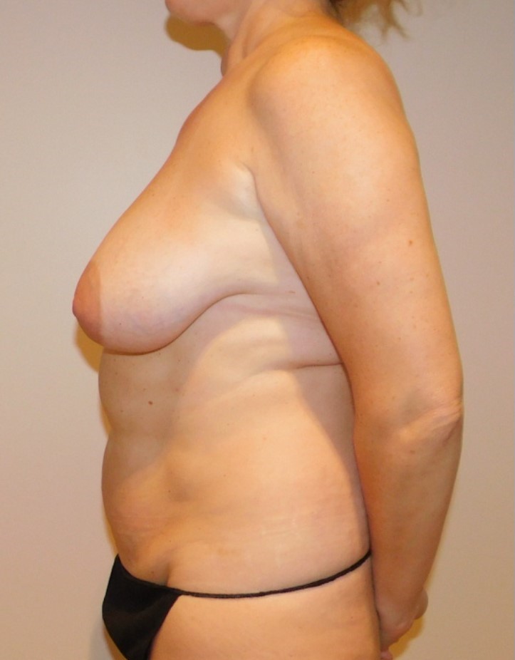 Before Image: Mommy Makeover - left-side