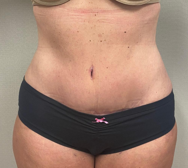 After Image: Tummy Tuck - front