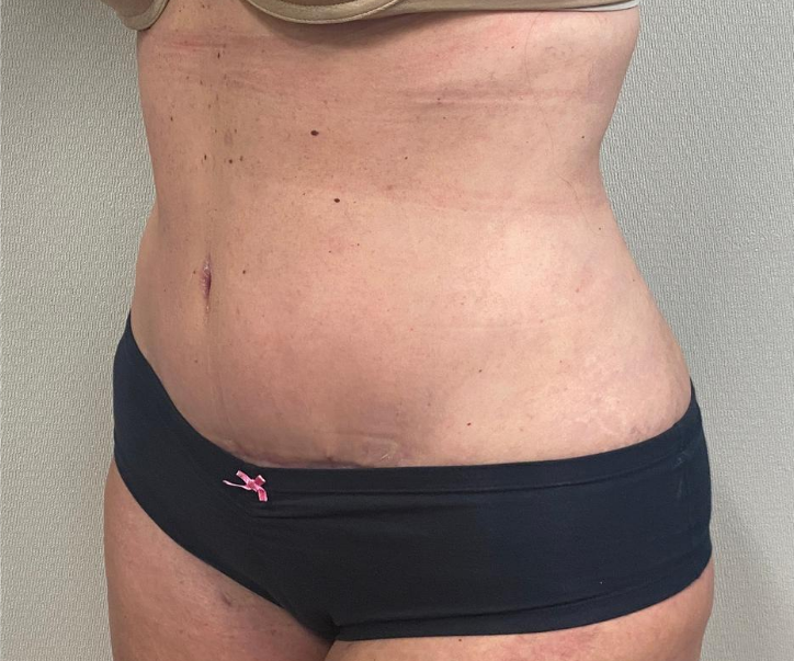 After Image: Tummy Tuck - left-front-oblique