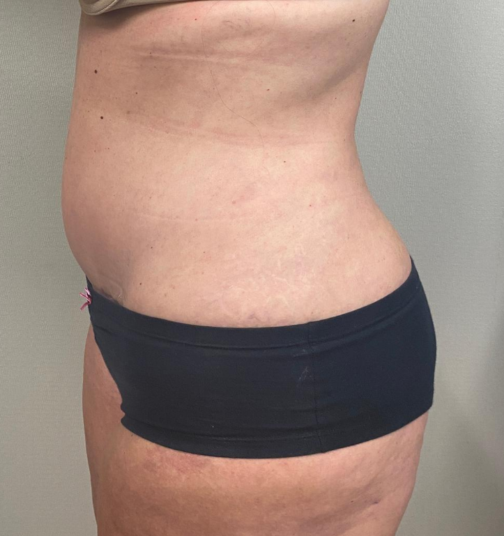 After Image: Tummy Tuck - left-side