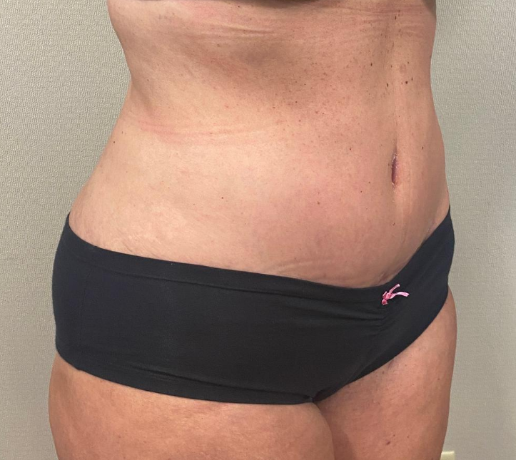 After Image: Tummy Tuck - right-front-oblique