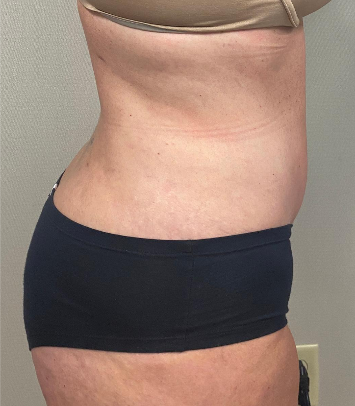 After Image: Tummy Tuck - right-side