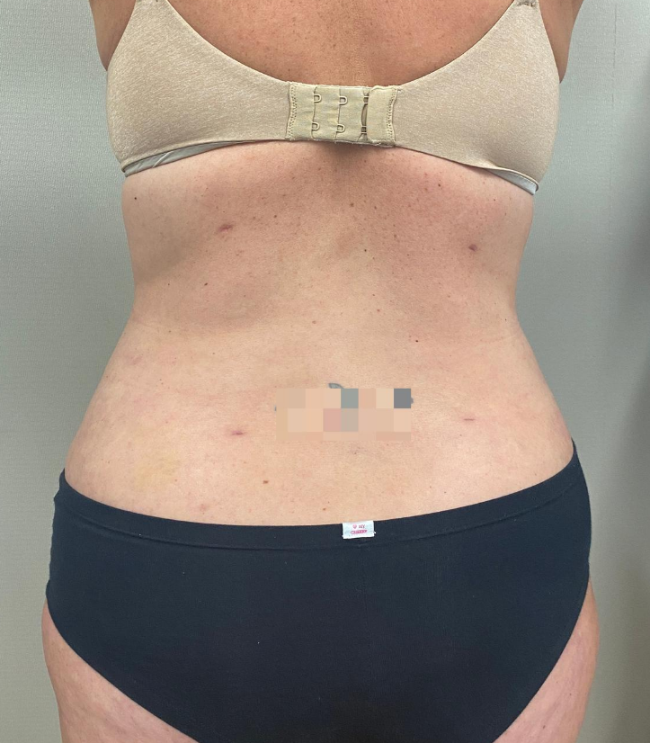 After Image: Tummy Tuck - back