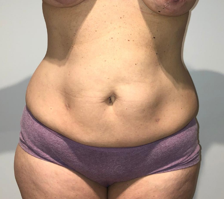 Before Image: Tummy Tuck - front