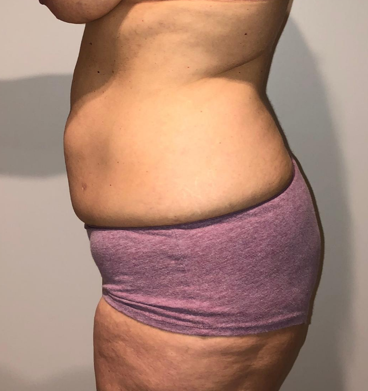 Before Image: Tummy Tuck - left-side