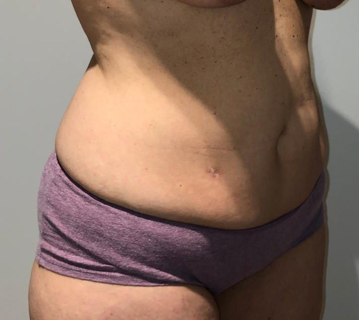 Before Image: Tummy Tuck - right-front-oblique