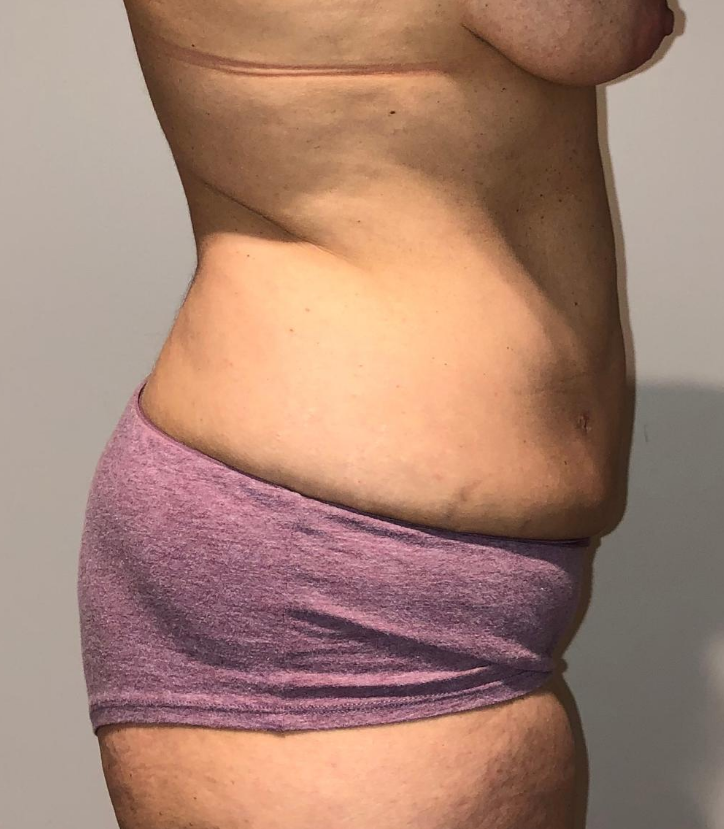 Before Image: Tummy Tuck - right-side