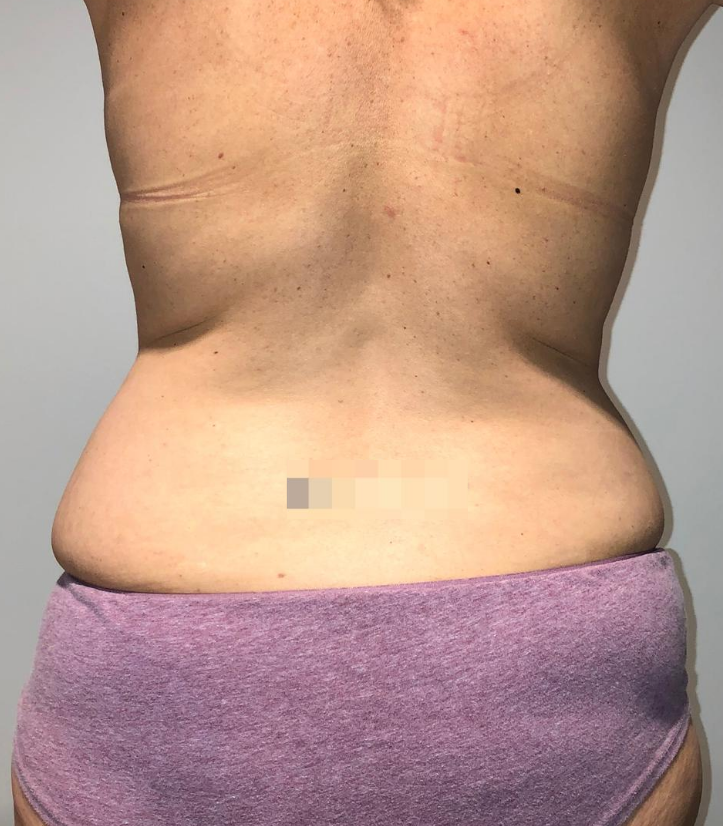 Before Image: Tummy Tuck - back