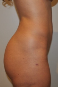 After Image: Brazilian Buttock Lift