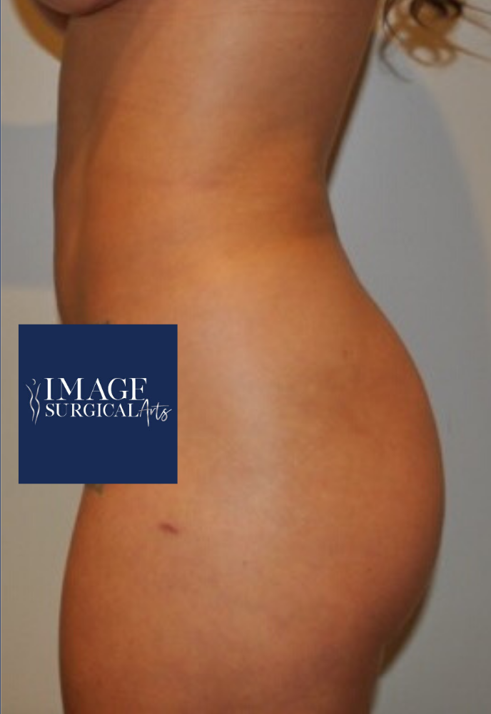 After Image: Brazilian Buttock Lift - left-side