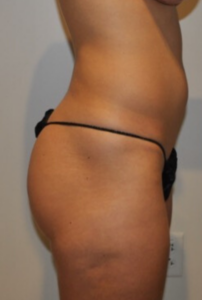 Before Image: Brazilian Buttock Lift