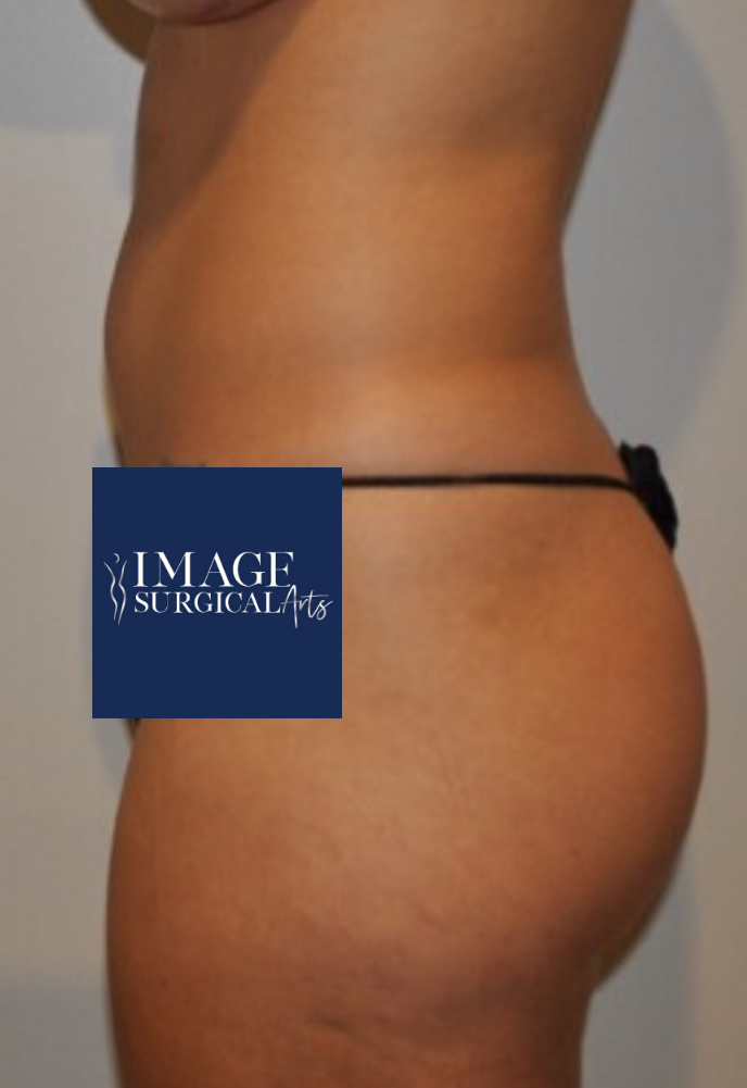 Before Image: Brazilian Buttock Lift - left-side