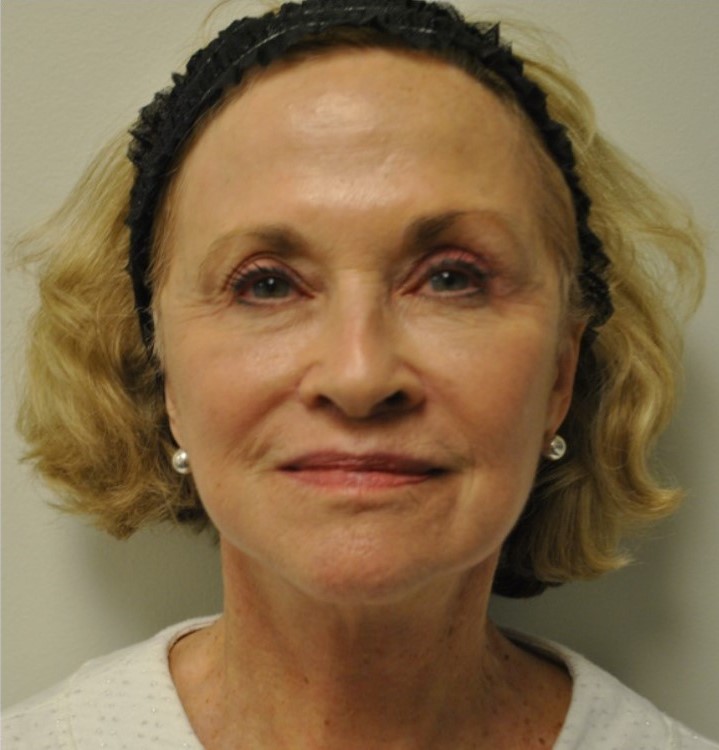 After Image: Facelift and Neck Lift - front