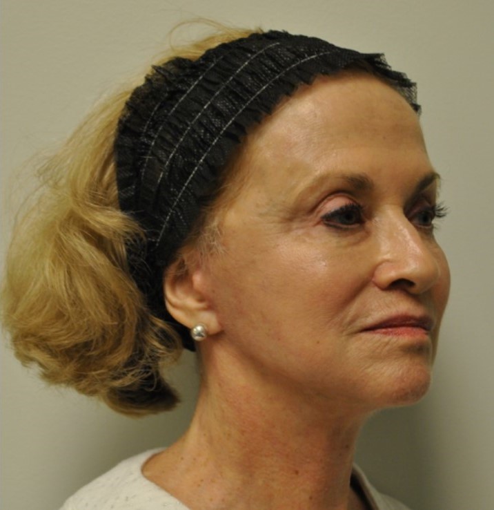 After Image: Facelift and Neck Lift - right-front-oblique