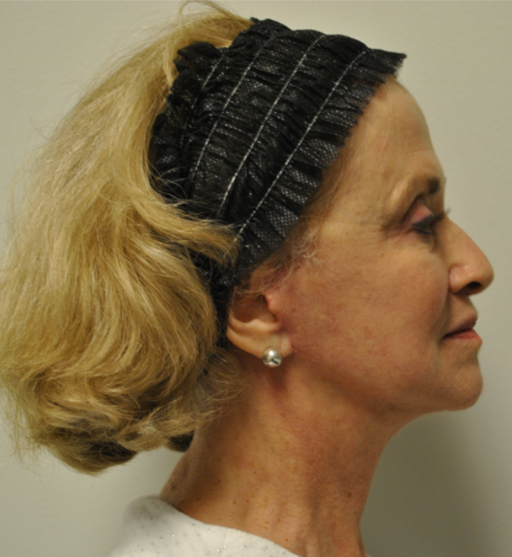 After Image: Facelift and Neck Lift - right-side