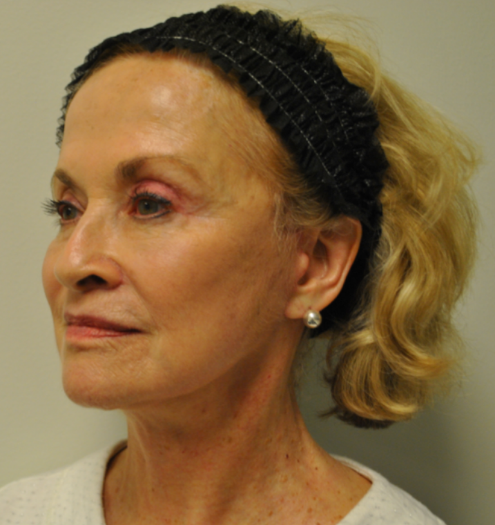 After Image: Facelift and Neck Lift - left-front-oblique