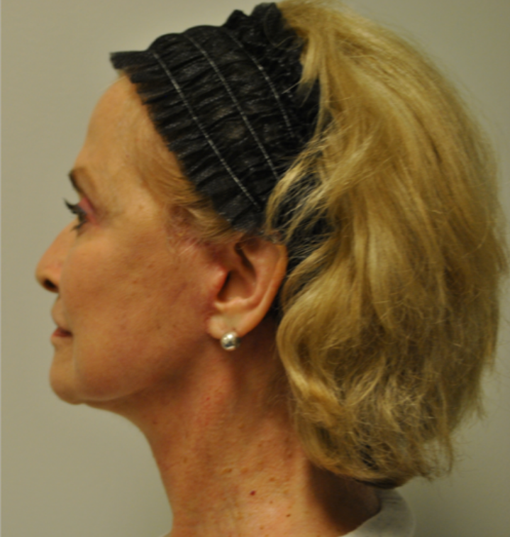 After Image: Facelift and Neck Lift - left-side