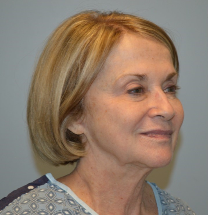 Before Image: Facelift and Neck Lift - right-front-oblique