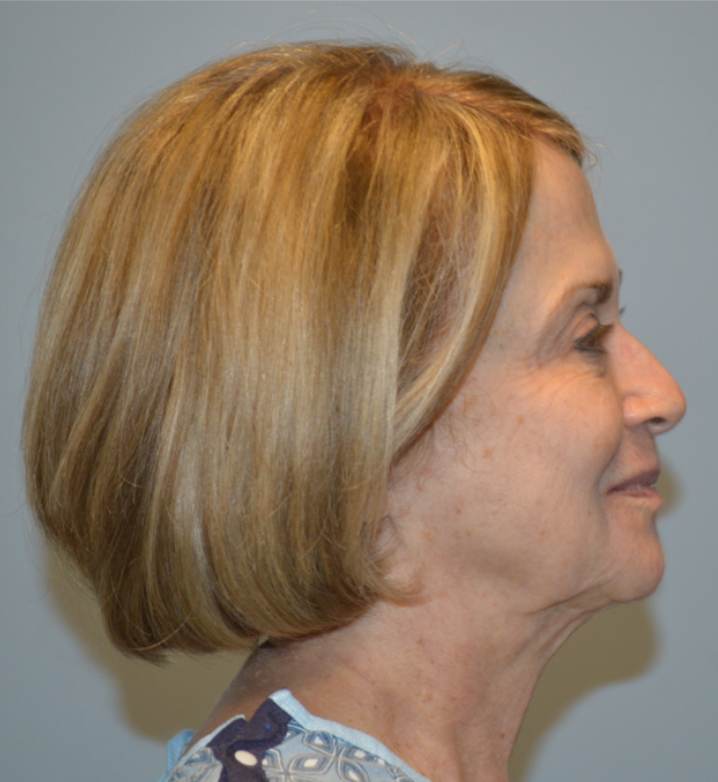 Before Image: Facelift and Neck Lift - right-side