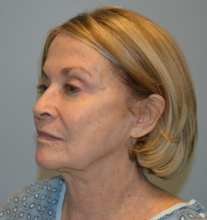 Before Image: Facelift and Neck Lift - left-front-oblique