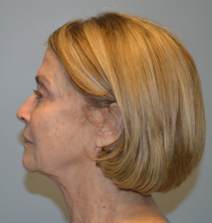 Before Image: Facelift and Neck Lift - left-side