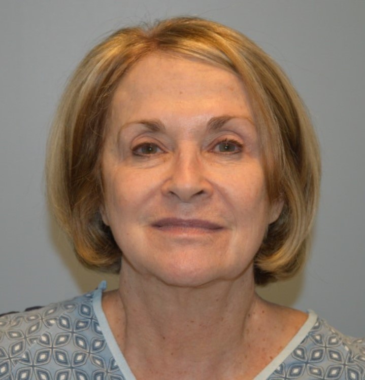 Before Image: Facelift and Neck Lift - front