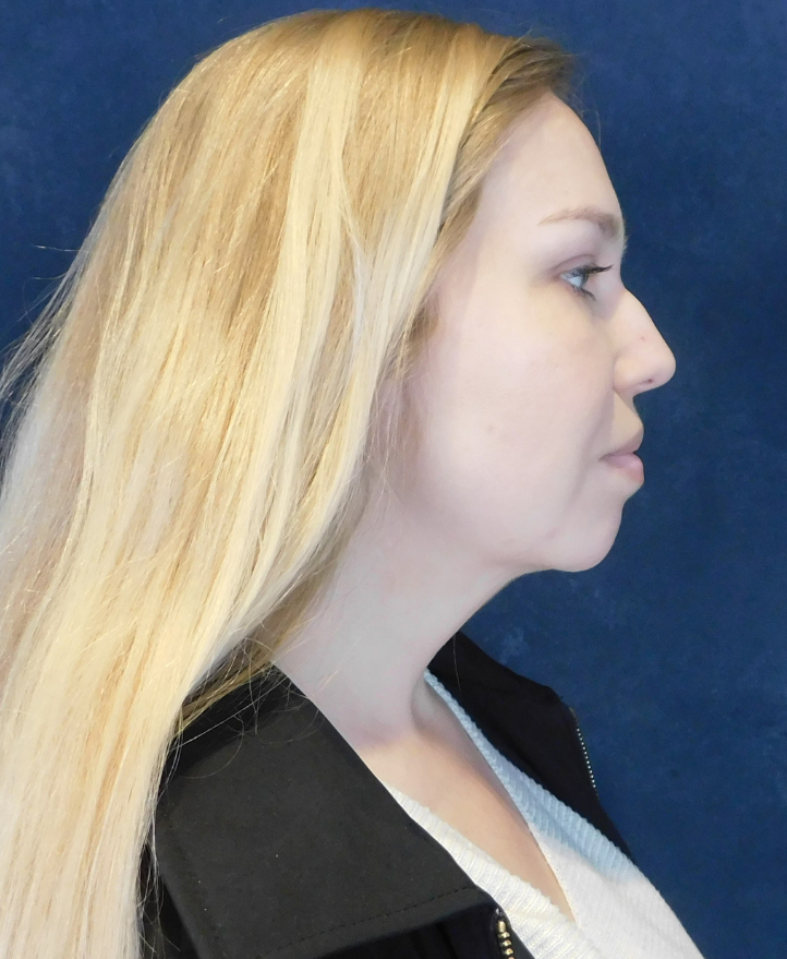 After Image: Neck Liposuction with Skin Tightening (Renuvion) - right-side