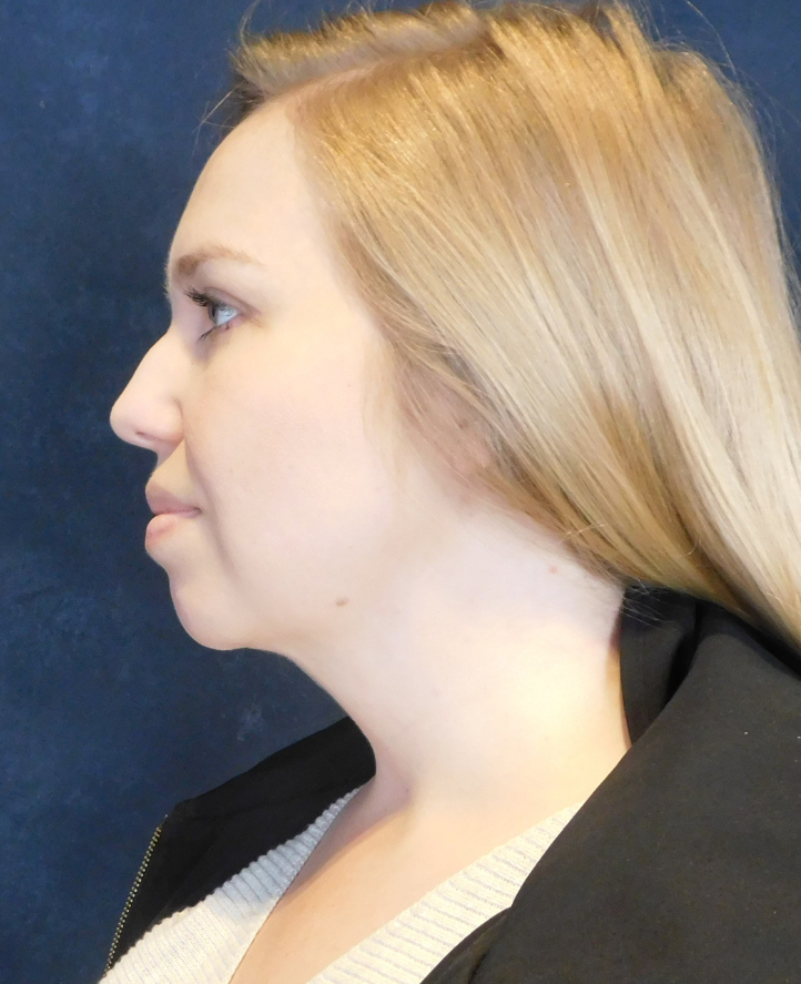 After Image: Neck Liposuction with Skin Tightening (Renuvion) - left-side