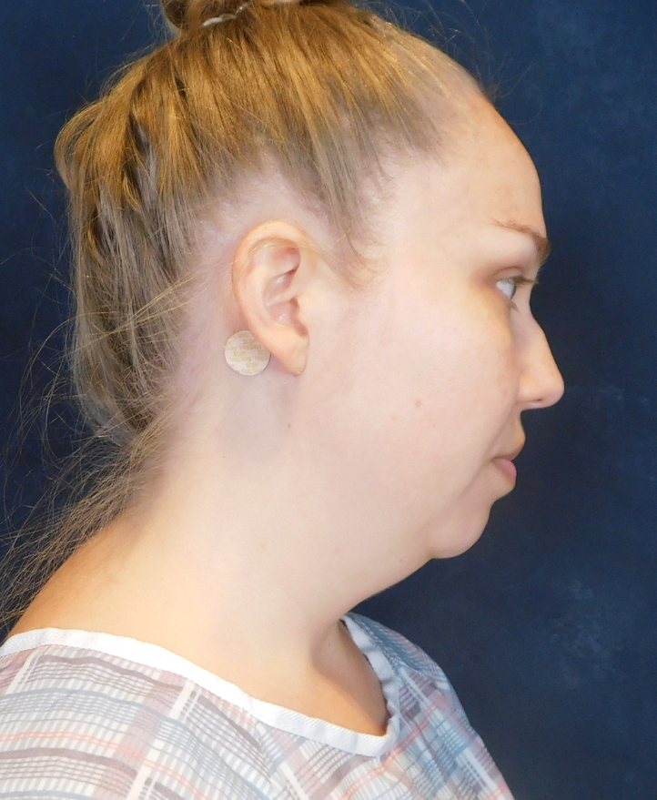 Before Image: Neck Liposuction with Skin Tightening (Renuvion) - right-side