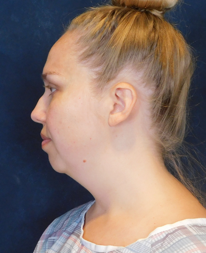 Before Image: Neck Liposuction with Skin Tightening (Renuvion) - left-side