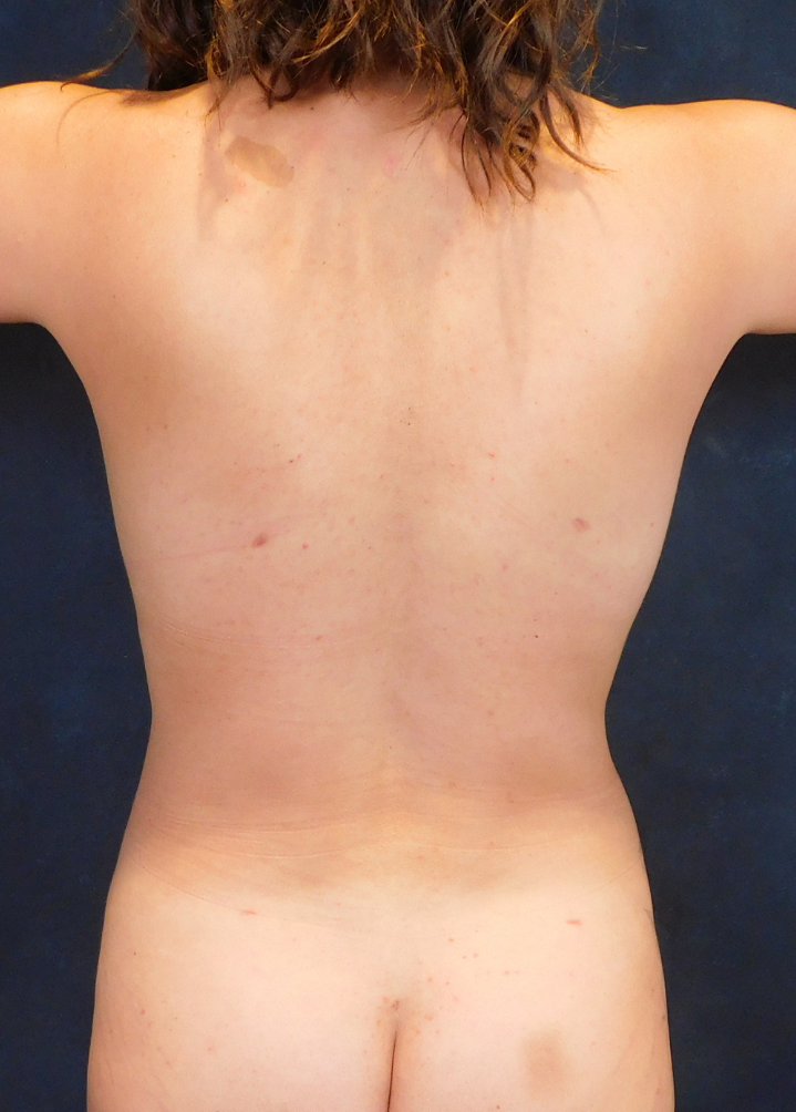 After Image: Standard Liposuction and Breast Augmentation - back