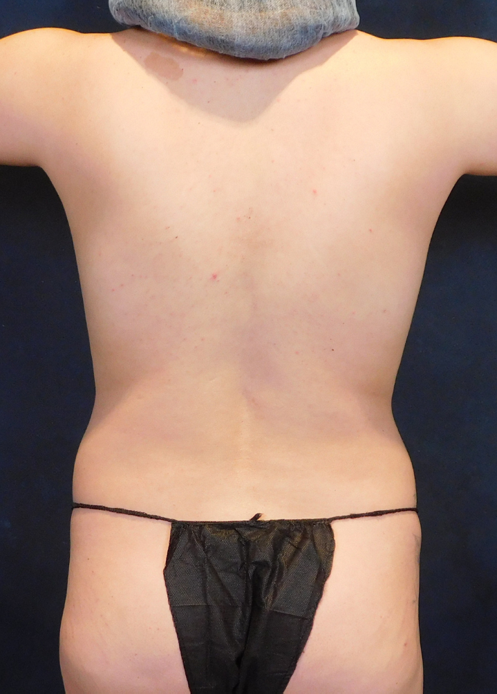 Before Image: Standard Liposuction and Breast Augmentation - back